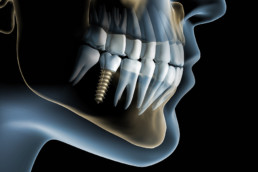 Oral surgery teeth implants Brisbane