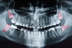 Wisdom teeth oral surgery Brisbane